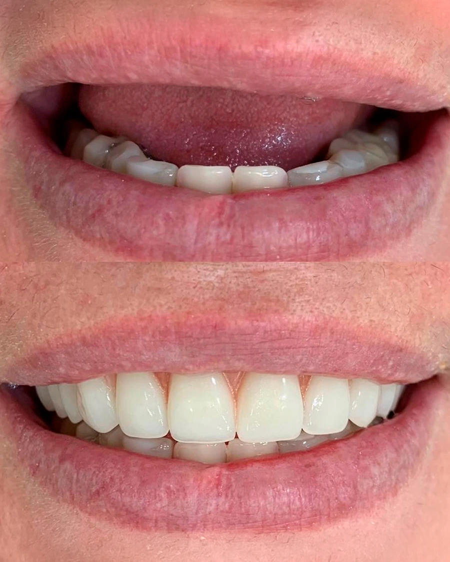 Resultado de tratamento com implantes TAKUME