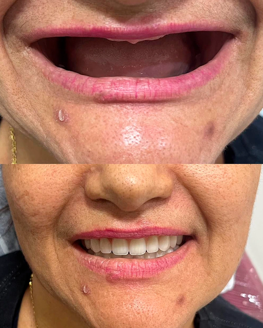 Implantes odontológicos TAKUME