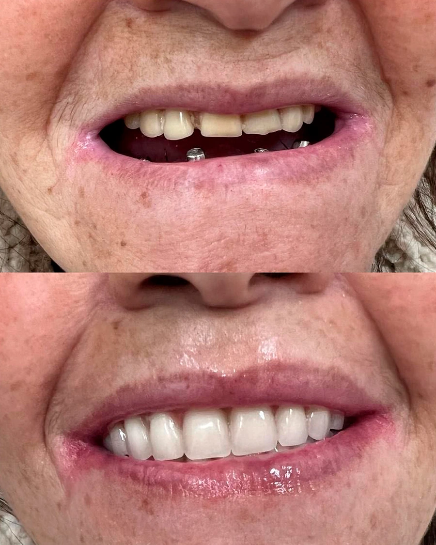 Tratamento com implantes TAKUME